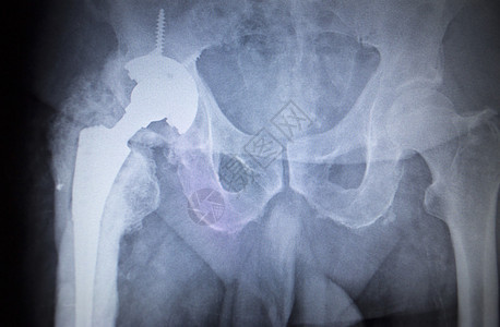 在骨折外科手术医院诊所中被扫描的人体骨骼蓝色灰调臀部关节X图片