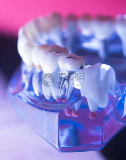 牙科医的牙齿模型显示牙凝胶口香糖根管运河石膏腐烂图片