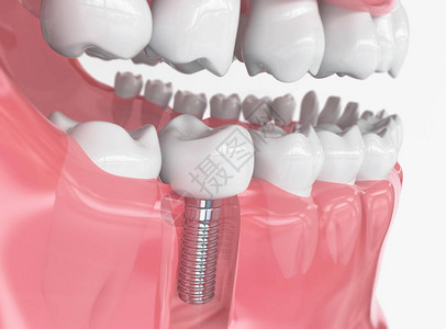 牙齿人类植入物牙科概念人类牙齿或假牙图片