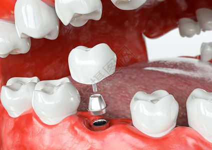牙或假牙3D的切入过程图片