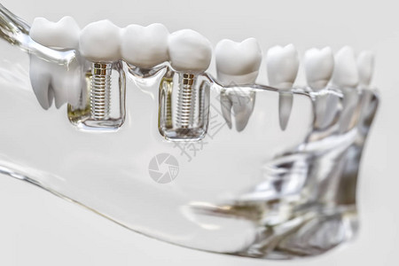 牙齿人类植入物图片