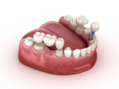 用植入和冠状复牙医学上准确的3D图片