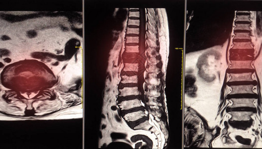 MRI脊椎显示脊髓转图片