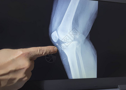 用医生巫婆的手指着骨折的膝盖X光片背景图片