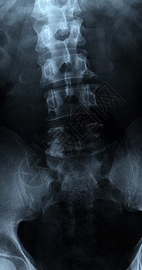 扫描腰椎前后位X光片图片