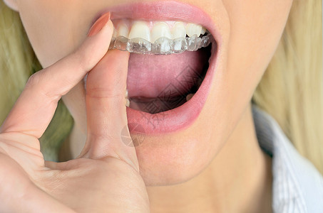 女人把护齿套在牙齿上背景图片