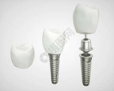 在白色上拆卸的牙种植体图片