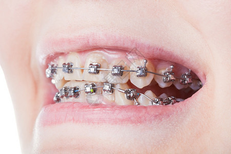 牙上的牙科钢括号在整牙图片