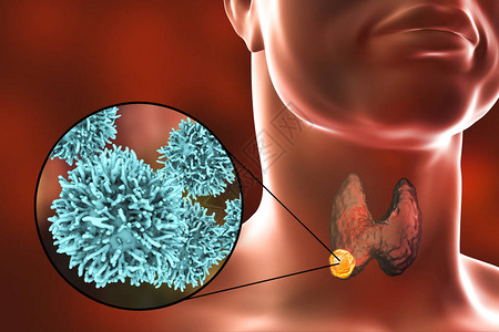 甲状腺癌3D图解显示甲状腺人体内肿瘤和甲状腺背景图片