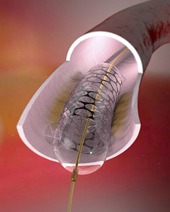 腰椎管狭窄症动脉和里面的支架支架是植入狭窄动脉以保持动脉畅通的网状管带有支架的球囊导管通常用于血管成形术以扩插画