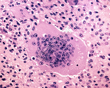 来自破骨细胞的多核巨细胞人体骨巨细胞瘤的活检图片