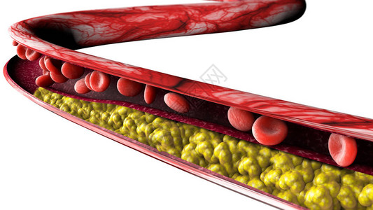 胆固醇形成图片