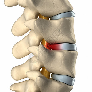椎间盘突出压迫脊髓背景图片