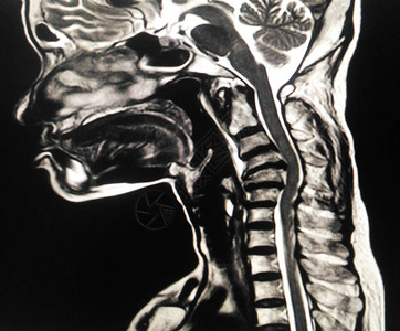 MRICSpineagirl67yearsold压缩骨折在C4和C5脊椎的中位图片