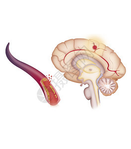 描述缺血中风或脑血管意外CVA图片
