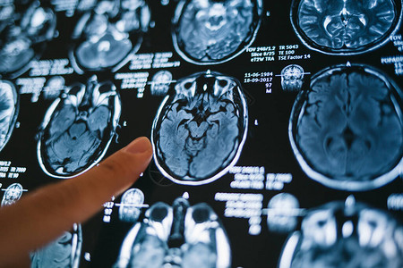 神经外科指出大脑磁共振图像MRI头部扫描医背景