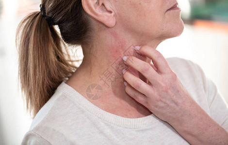 女人发痒抓挠脖子过敏症状图片