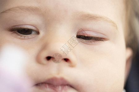一个小孩特写的眼睑上的白色疙瘩眼睑结膜炎的症上眼图片