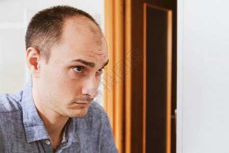 男型脱发问题概念年轻的白种人看着担心秃顶男图片