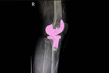 在膝关节炎完全手术后病人右膝图片