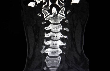 C2宫颈脊椎骨折的图片