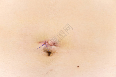 阑尾炎切除后的年轻身体疤痕腹腔镜手术后的小背景图片