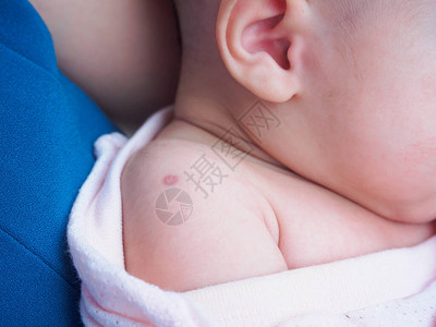 用于防治结核病的BacillusCalmetteGuerinBCG疫苗对新生儿婴肩图片