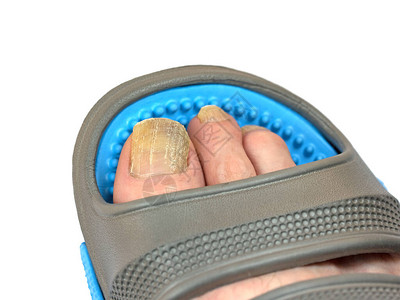 脚趾甲真菌甲癣脚趾人字拖的脚图片