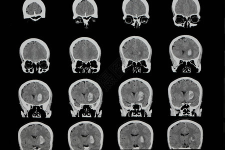 脑计算机断层摄影CT扫描一名病人在左脑半球大面积出血液中风图片