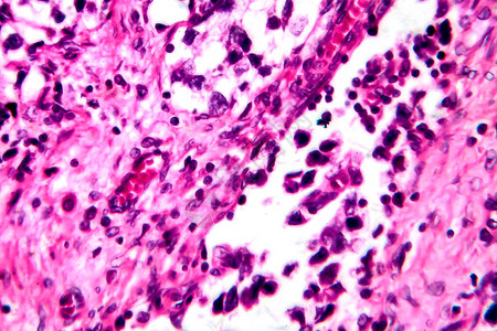 睾丸精原细胞瘤图片