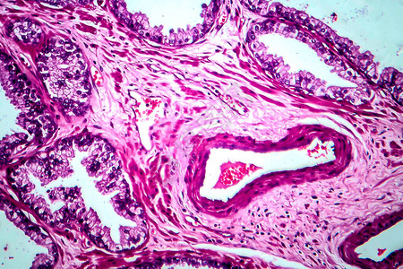 前列腺癌轻显微镜显背景图片