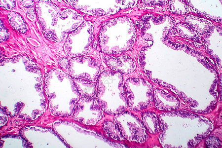 前列腺癌轻显微镜显背景图片