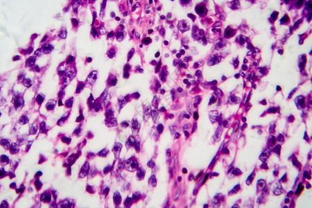 生殖细胞睾丸精原细胞瘤背景
