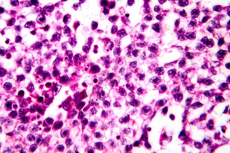睾丸精原细胞瘤图片