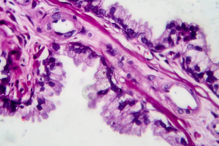 前列腺癌轻显微镜显背景图片