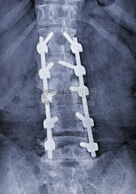 脊柱固定图库片图片