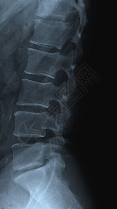 扫描一部左侧腰脊椎的射电图图片