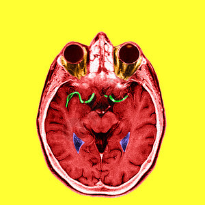 大脑前动脉和内侧动脉的亮点背景图片