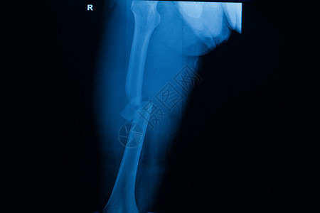 右股骨右大腿拍片X线骨折图片