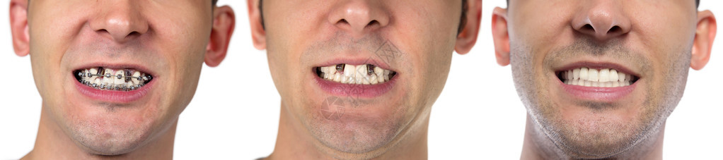 白色背景上有治愈牙齿的男人背景图片