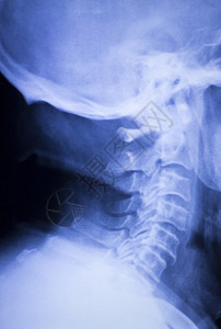 骨骼颈部脊椎脊椎和肩部受伤医疗X射线图片