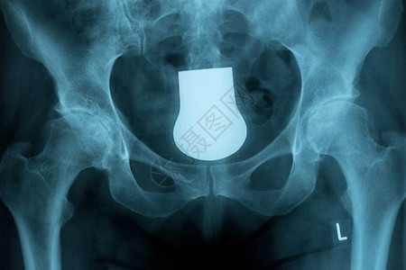 人体骨盆和脊柱X光照片图片
