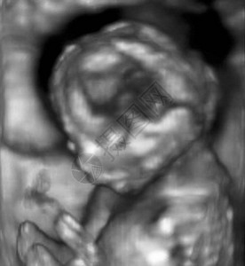 孕妇婴儿的超声波图片