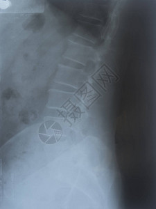 一个背部和腹部疼痛的老人脊椎和骨图片