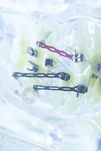 矫形牙医教授牙齿假牙模型塑料和金属括号连接器图片