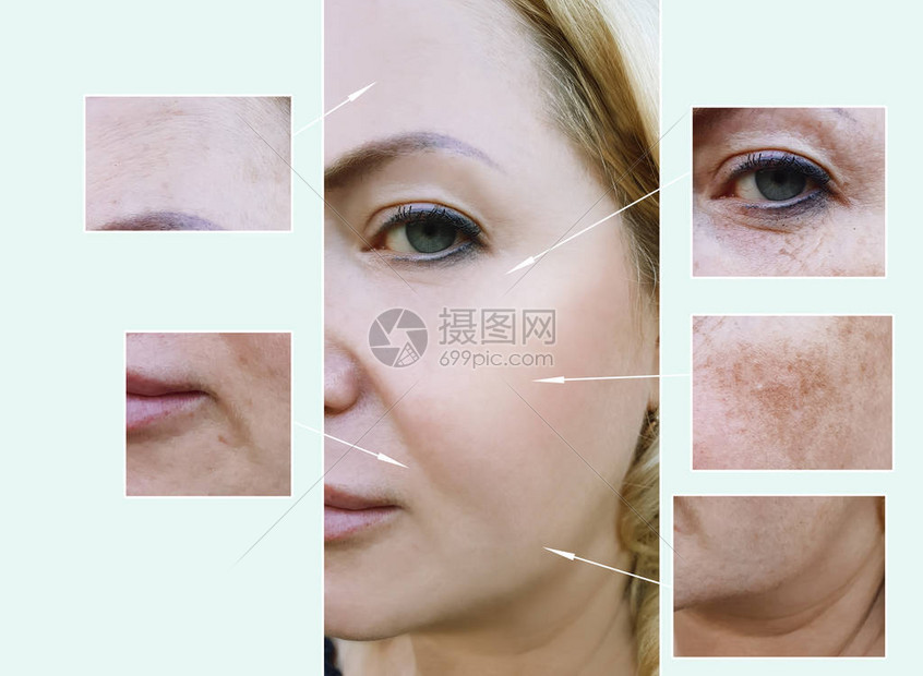 女人在手术前后脸上的皱纹色素沉着图片