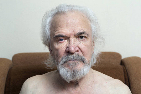 一位老人患有白内障和青光图片