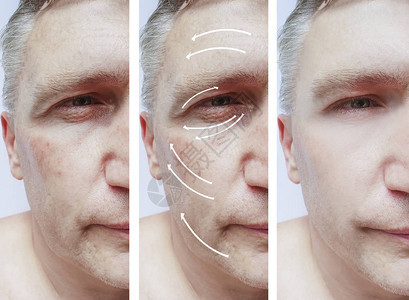 男人脸上的皱纹在程序前后和在图片