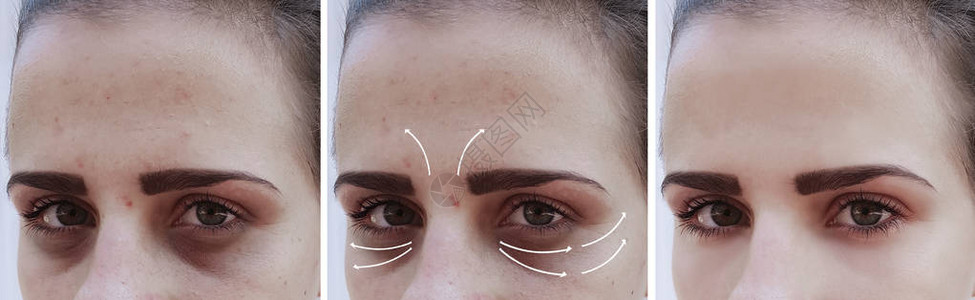 女人脸上的皱纹手术前图片