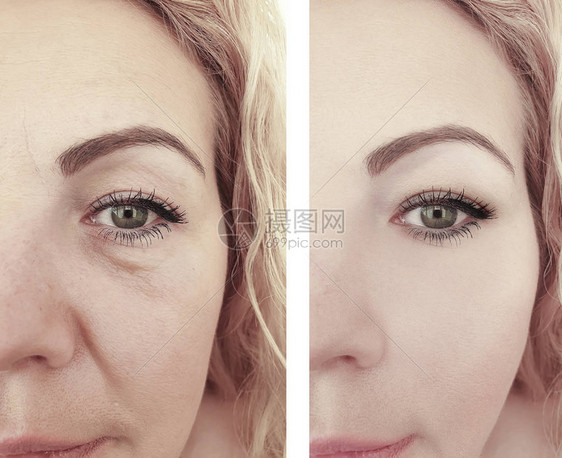 手术前后的女人脸眼皱纹图片